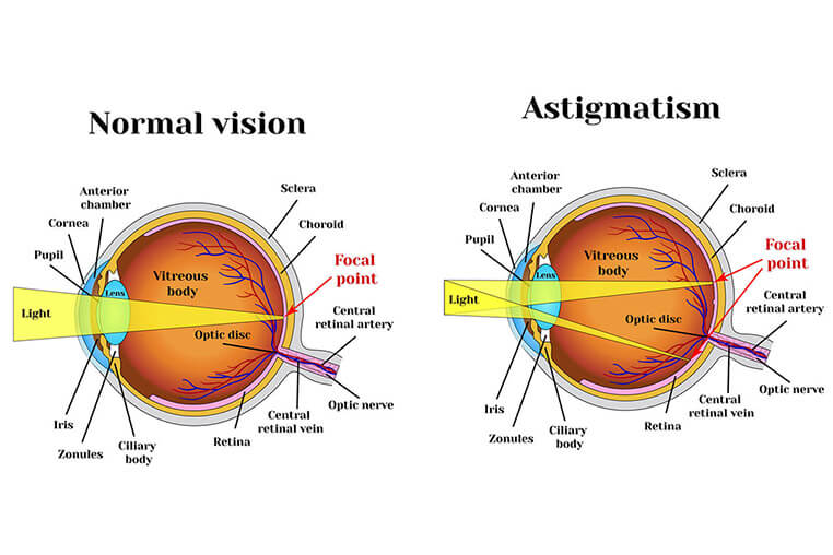 ce inseamna astigmatism miopic